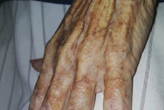 Waarom ze nog één keer roze nagels wilde: het aangrijpende verhaal